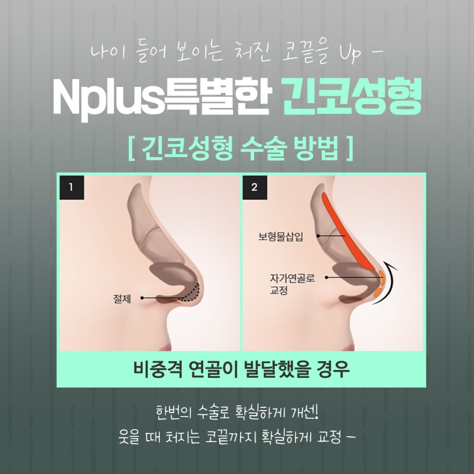 긴코수술을 통해 동안으로 관련 이미지 9
