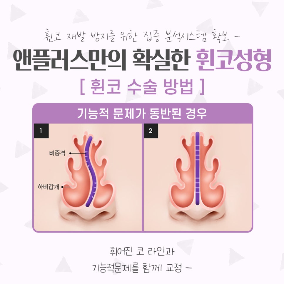 휜코성형후기 기능까지 확인해야 관련 이미지 11