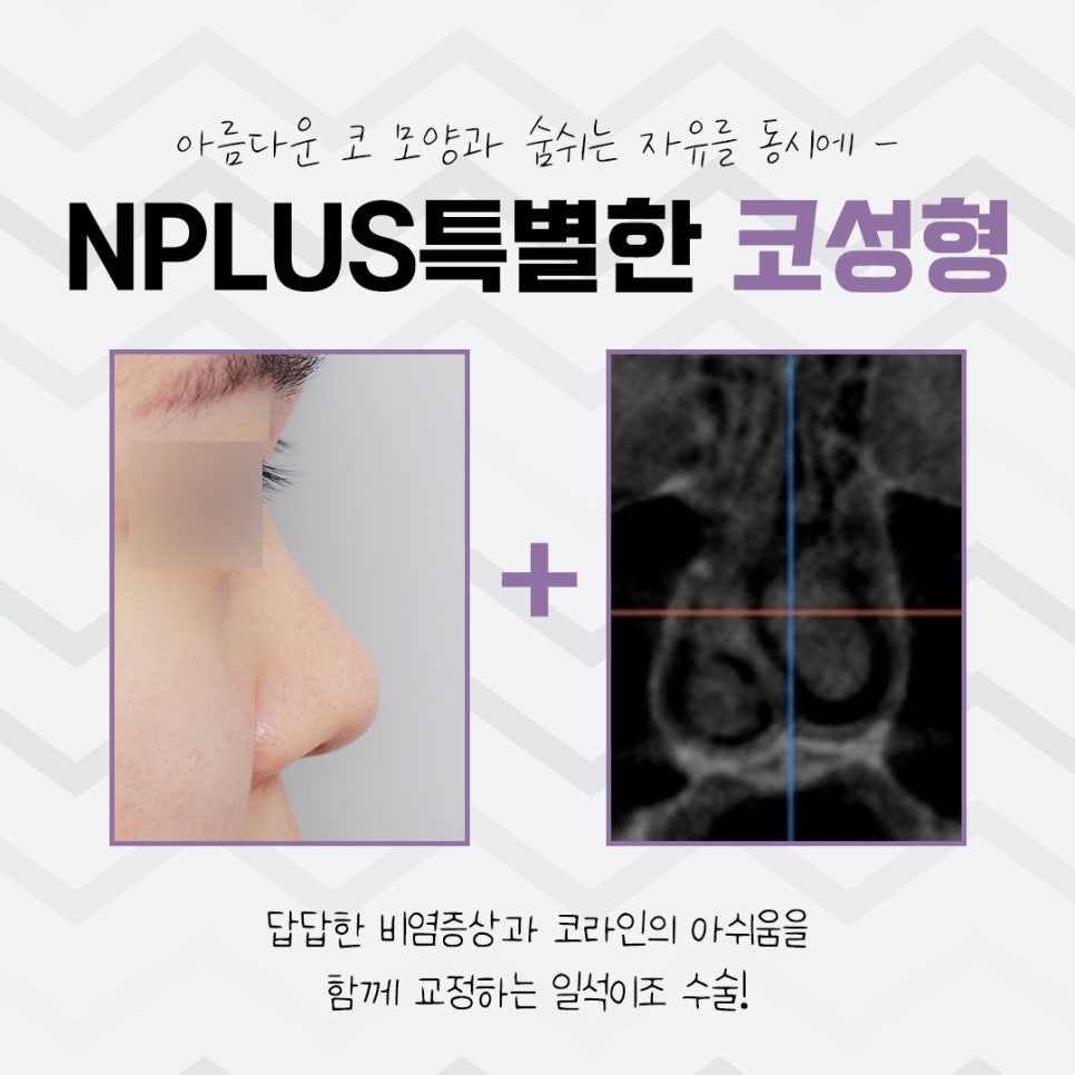 Before and After Nose Surgery: Looking into It Carefully image 3