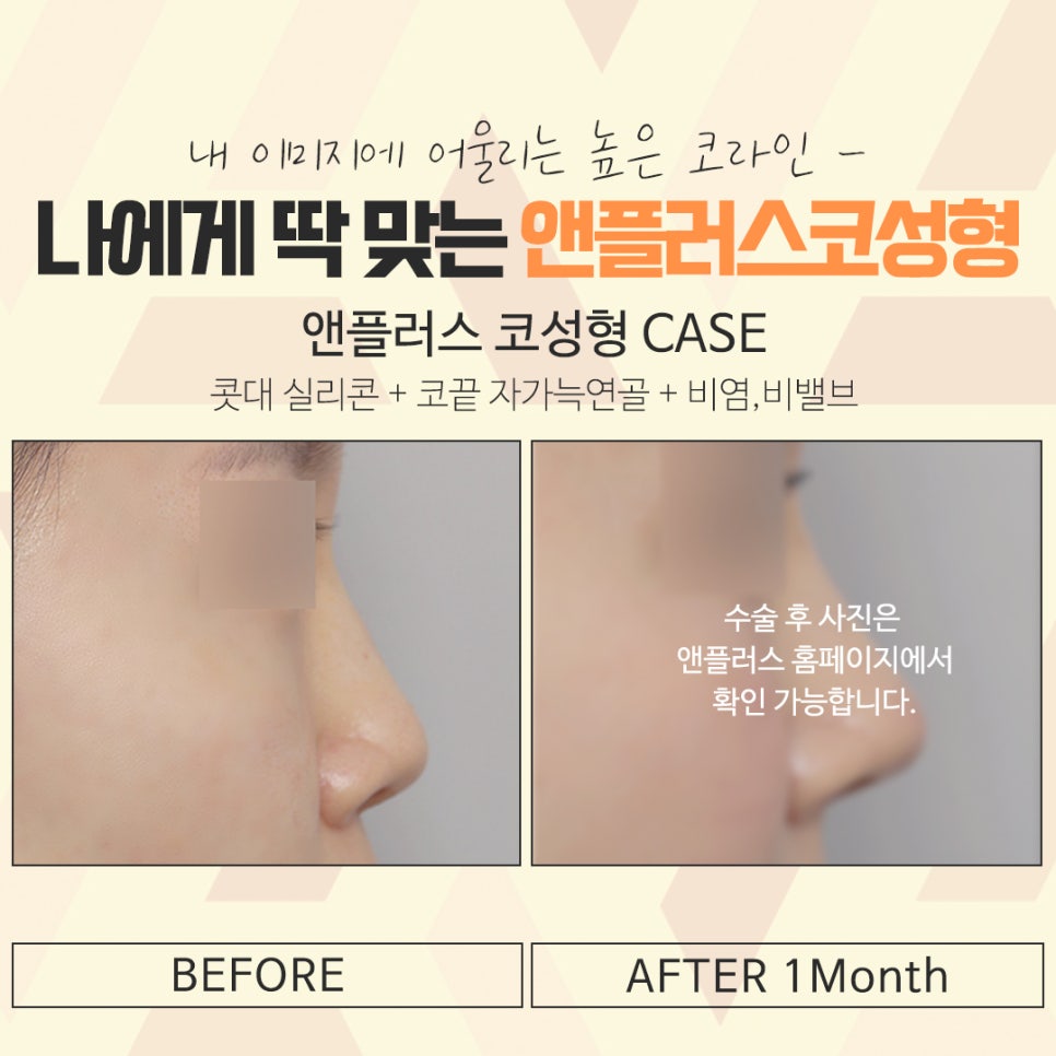 자가연골코수술을 통한 이미지 개선 관련 이미지 15