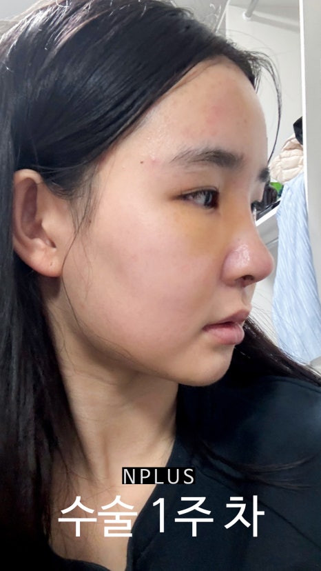 AN Plus Plastic Surgery Review: Silicone Nasal Bridge, Autologous Rib Cartilage Nasal Tip, Under-Eye Fat Repositioning, Fat Grafting image 5