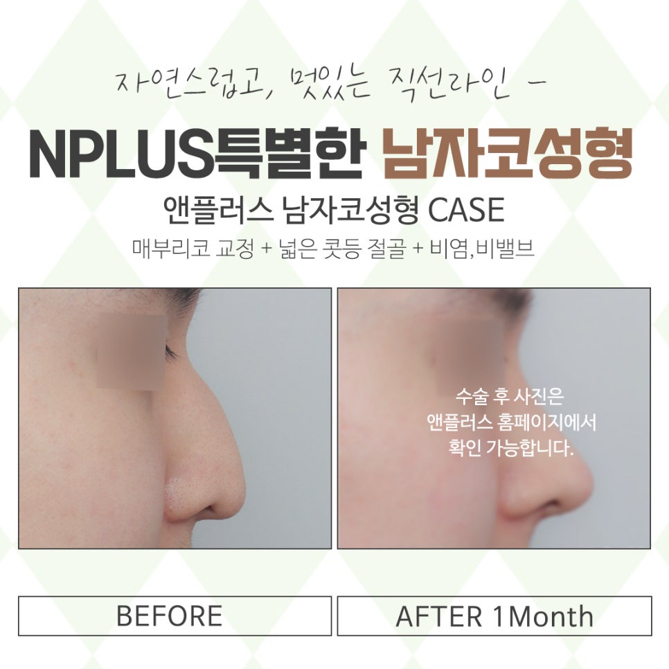남자코성형후기를 확인하고 이미지 개선 관련 이미지 15