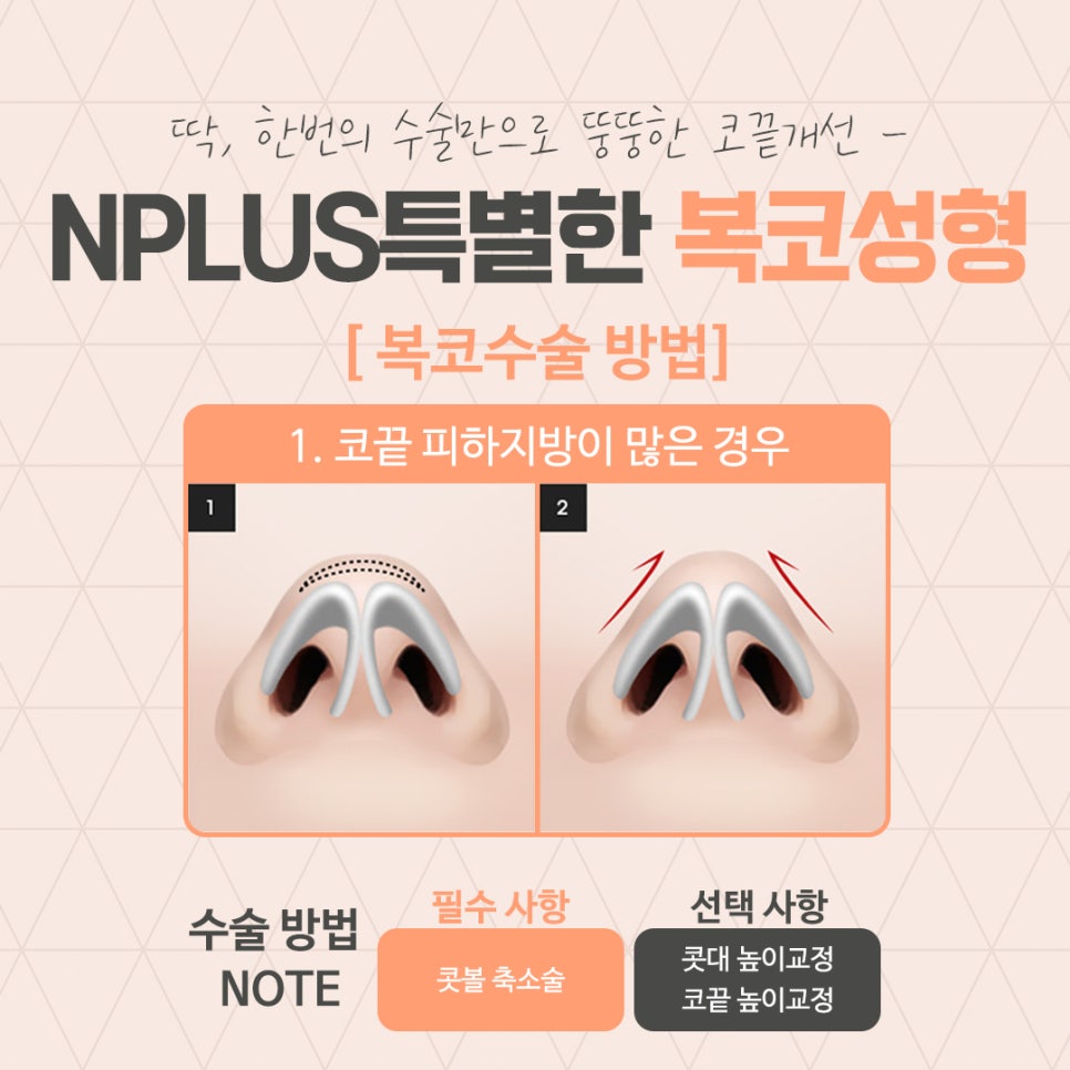 A Clear Bulbous Nose Surgery Review with Nasal Fat Removal image 6