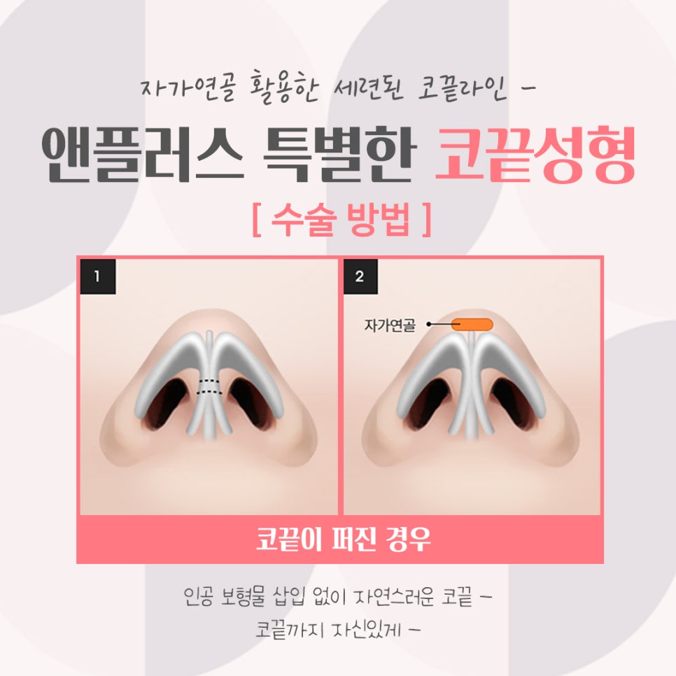 코끝성형후기로 세련된 코 라인 관련 이미지 11