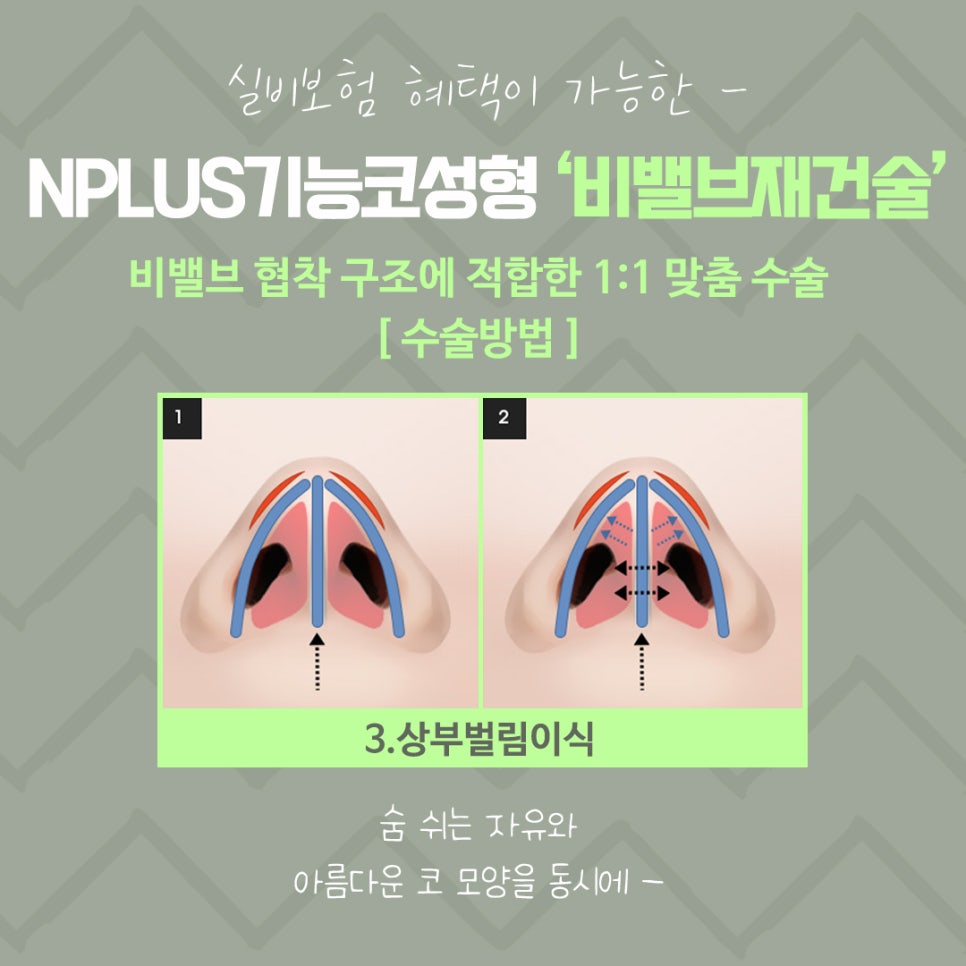 비밸브재건술을 통한 숨 쉬는 자유 관련 이미지 11