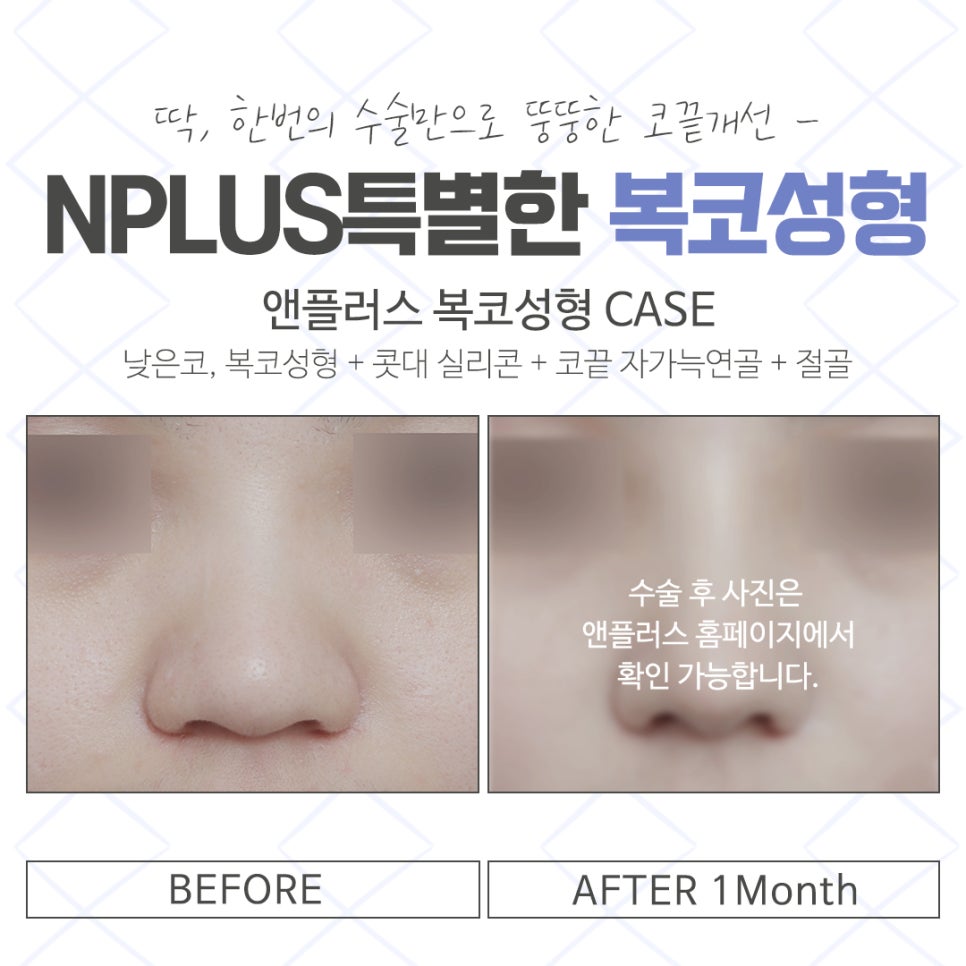 Post-Operative Review of Bulbous Nose Surgery, Improved Naturally image 15