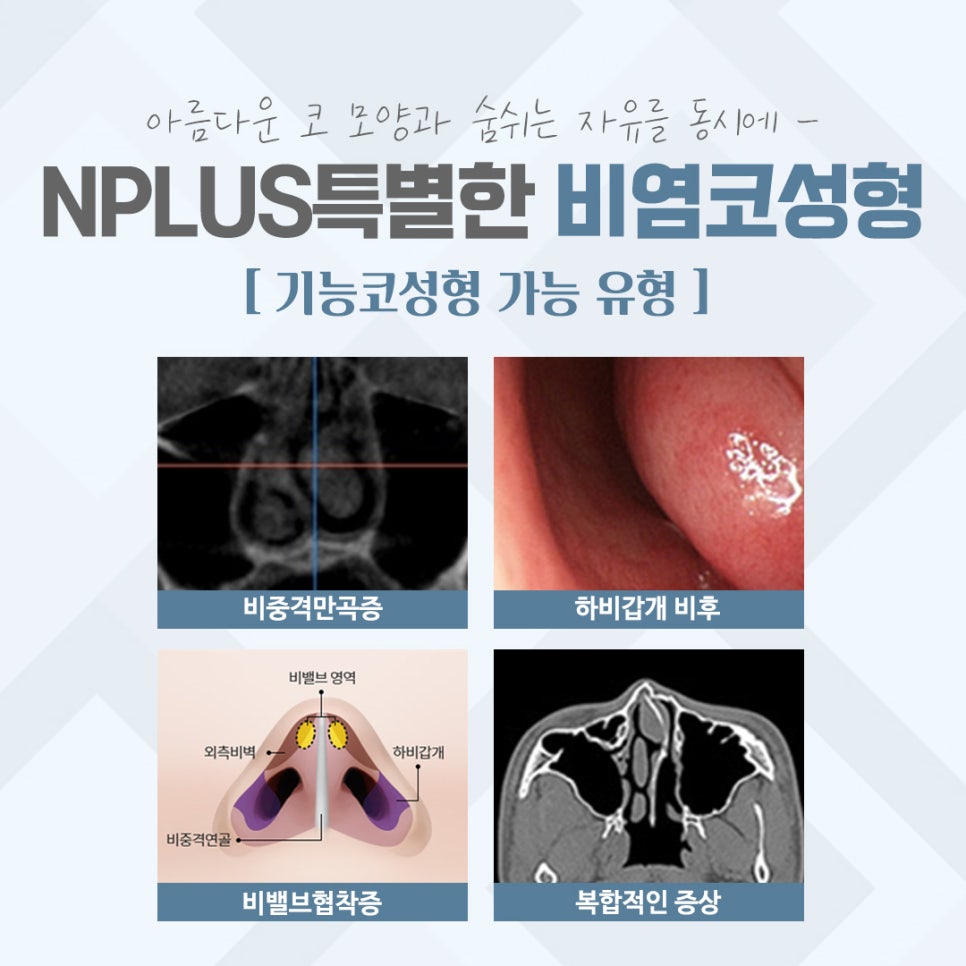 비염코수술후기 자세하게 알아보고 관련 이미지 4
