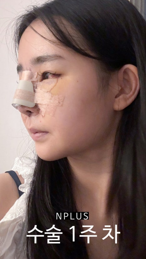 AN Plus Plastic Surgery Review: Silicone Nasal Bridge, Autologous Rib Cartilage Nasal Tip, Under-Eye Fat Repositioning, Fat Grafting image 4