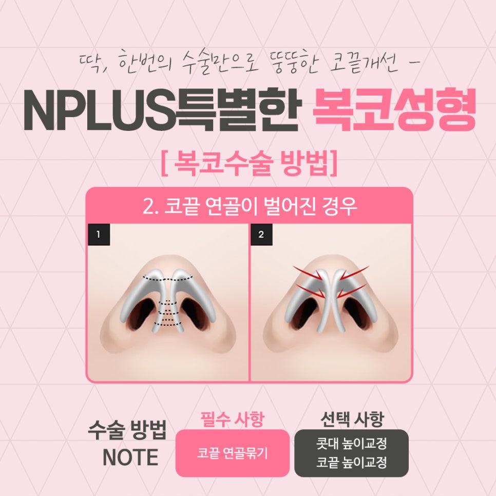 코지방제거를 통해 세련된 라인으로 관련 이미지 7