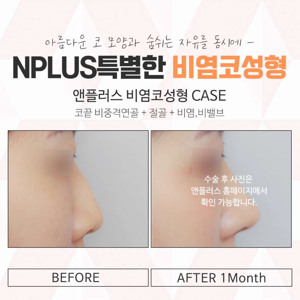 비염의원인과 해결 방법에 대해 관련 이미지 12