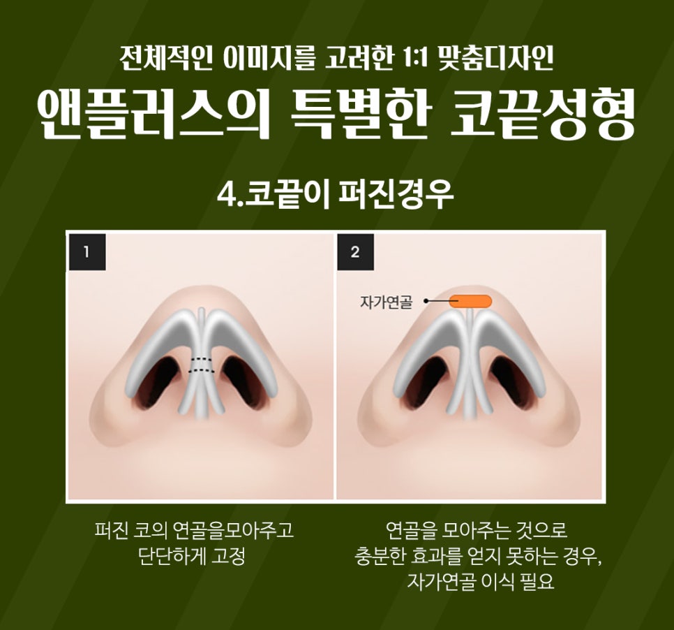 강남코성형 예쁜 코끝성형으로 이미지 개선 관련 이미지 8