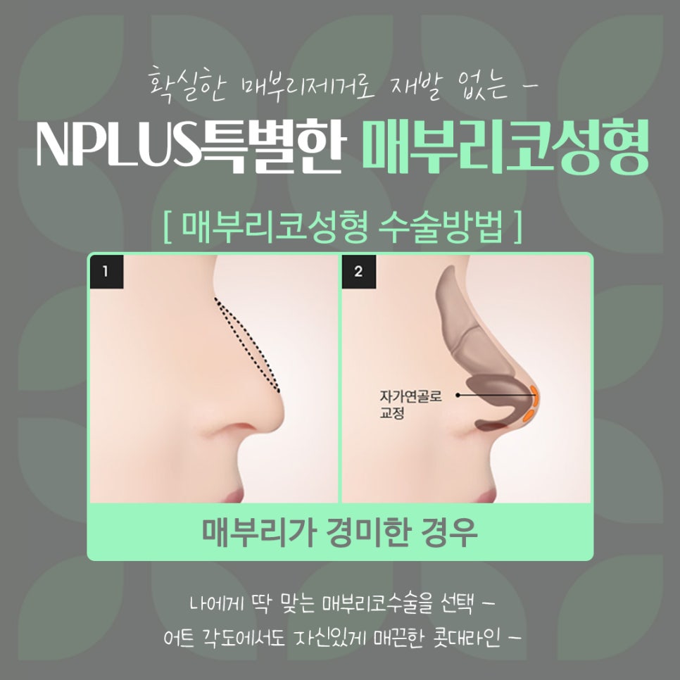 Septoplasty and Hump Nose Surgery Review, Considering Function Too image 11