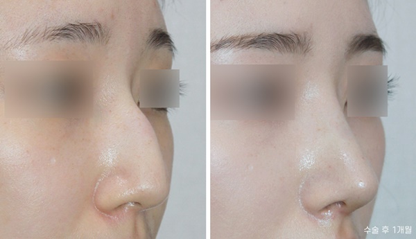 Hump Nose Osteotomy Surgery Review image 2