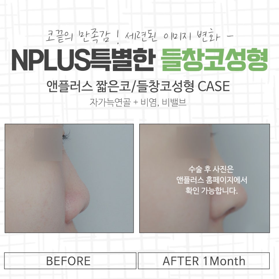 들창코성형 차이를 확인하고 관련 이미지 14