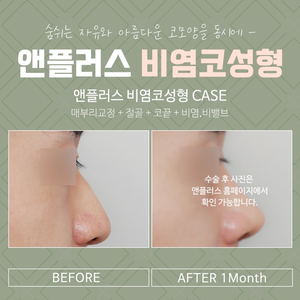 비염코성형후기 라인까지 고려하여 관련 이미지 15