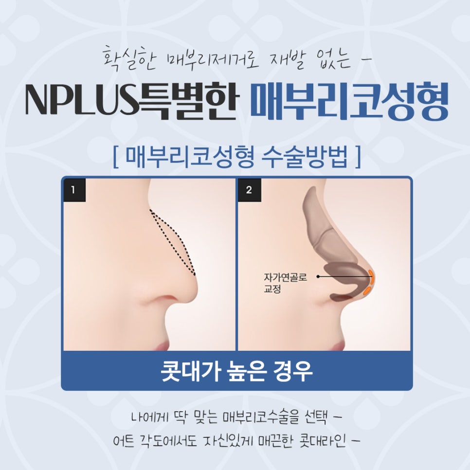 Hump Nose Surgery Review with an Accurate Diagnosis image 9
