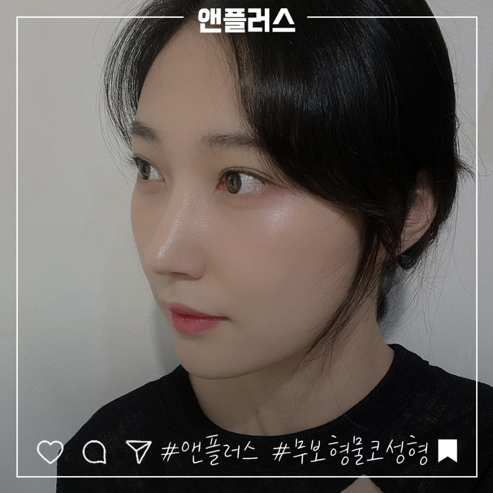 무보형물코수술을 통해 자연스러운 코라인으로 관련 이미지 11