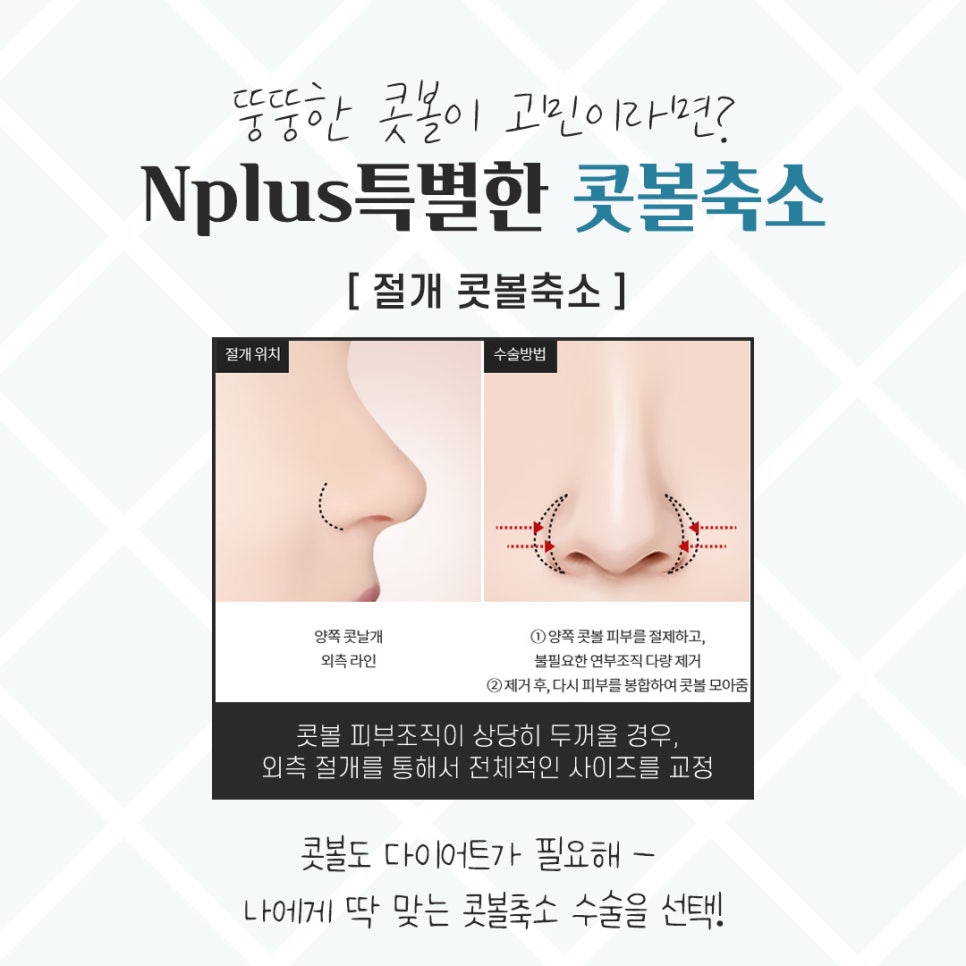 Choosing After Checking Rhinoplasty Alar Reduction Surgery Reviews image 9