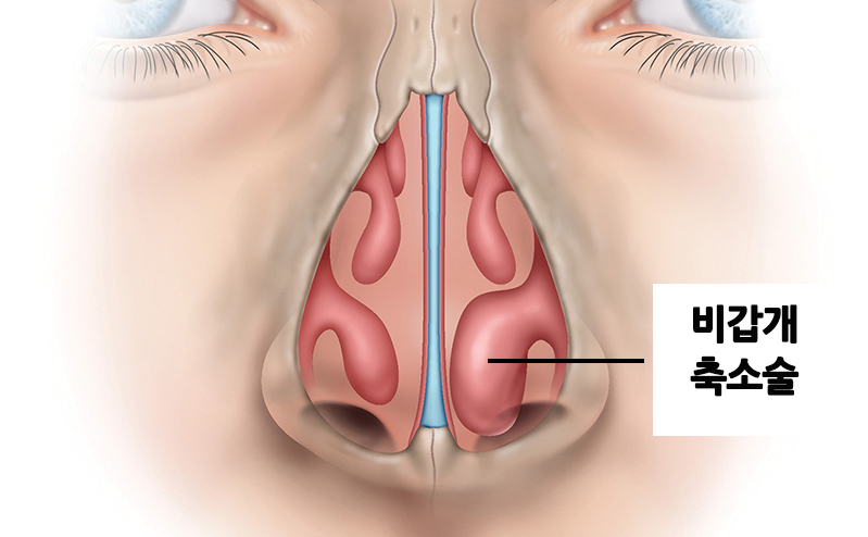 Be sure to research rhinoplasty for rhinitis before surgery! image 3