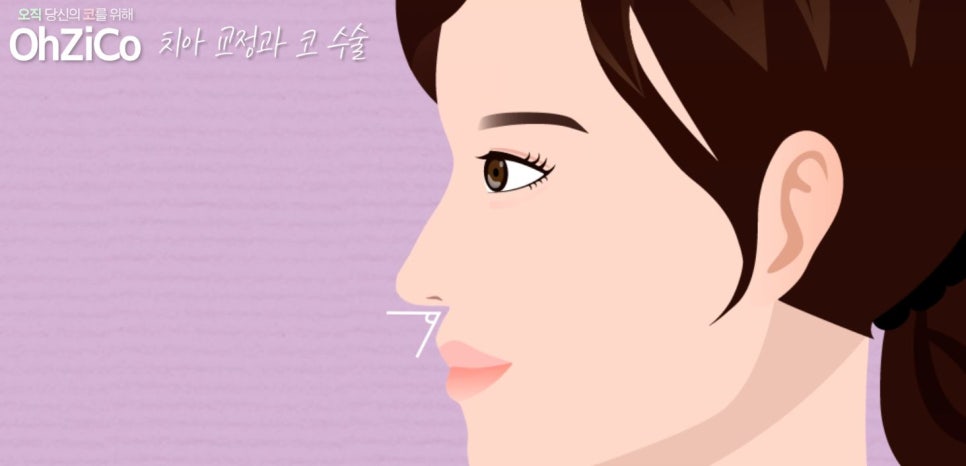 비순각수술 자연스럽고 예쁘게 관련 이미지 8