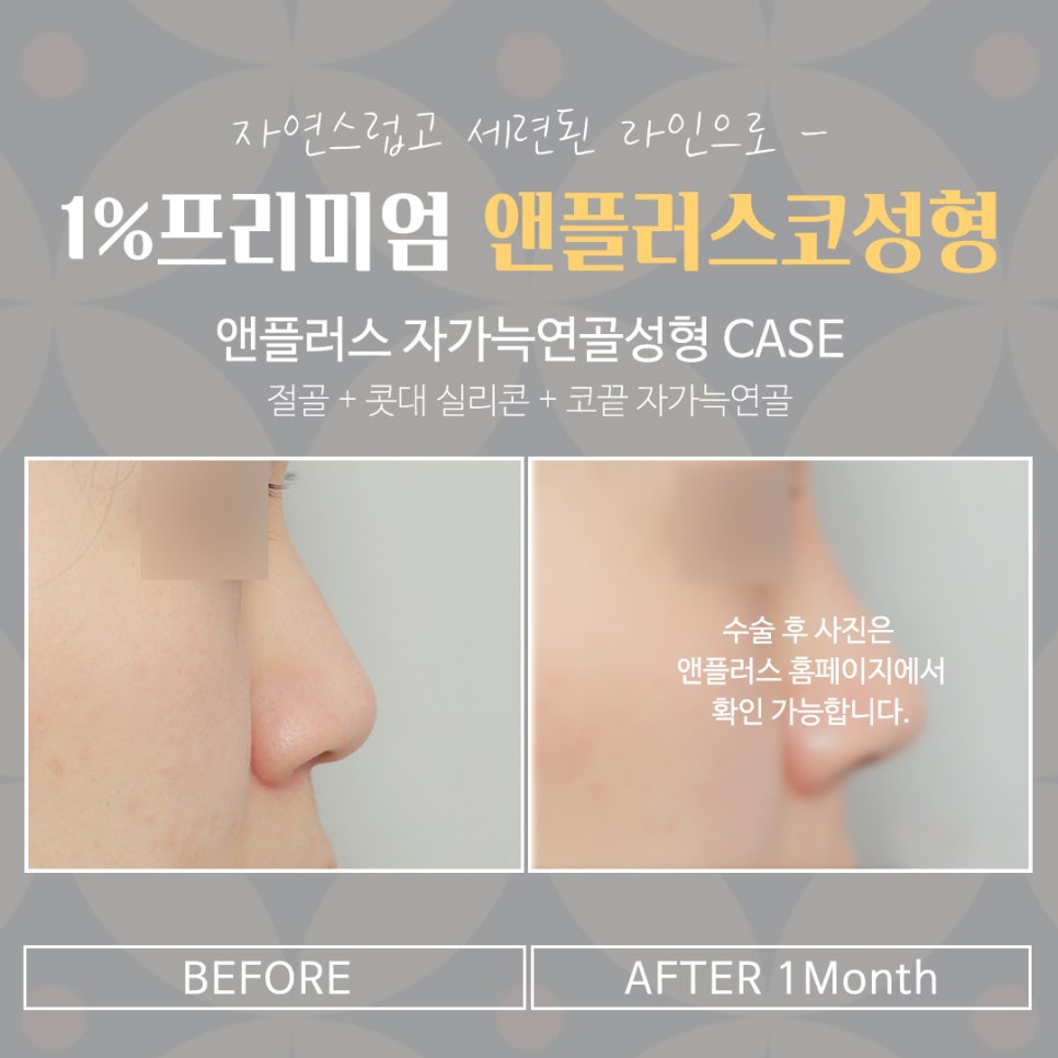 자가늑연골코수술 세련된 이미지로 관련 이미지 16