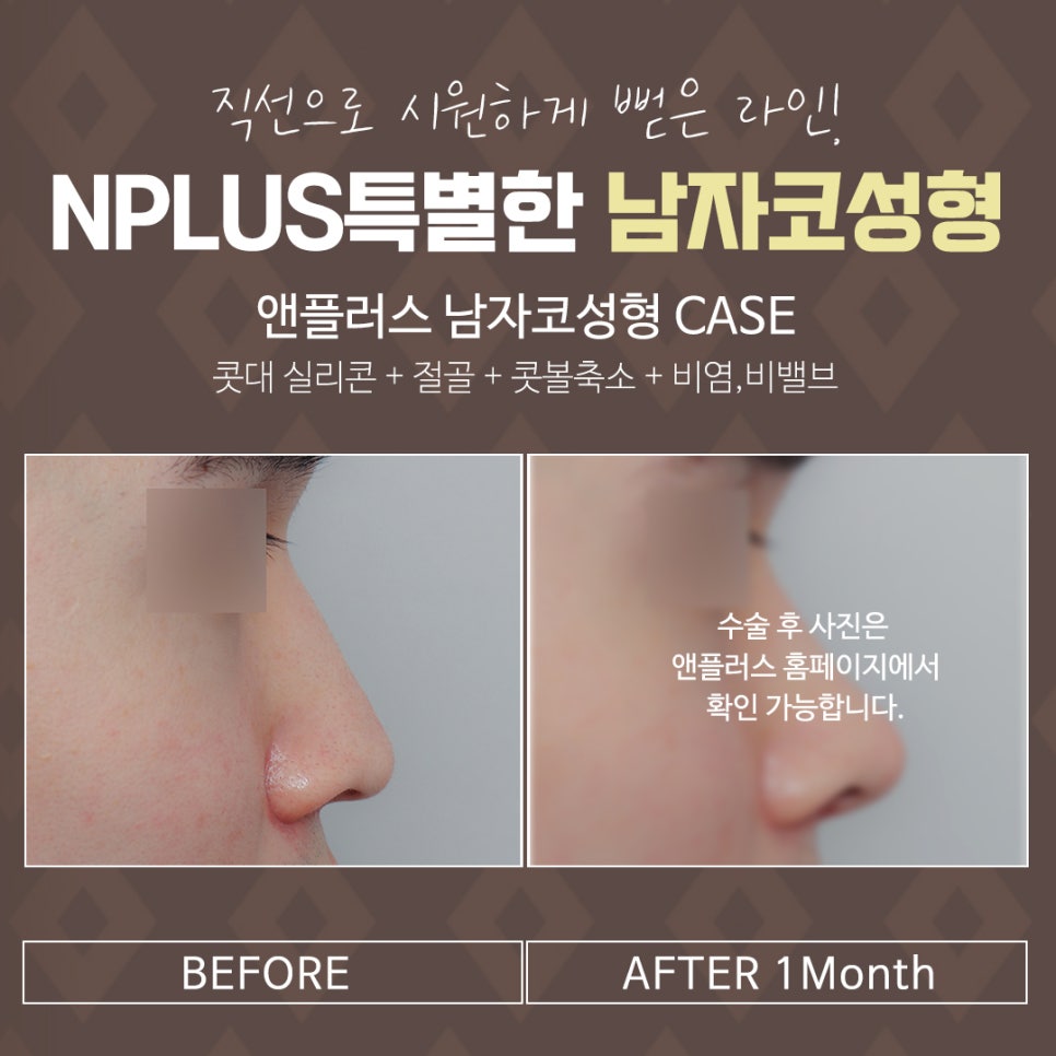 Achieving a Clear Line in Male Rhinoplasty Before and After image 16