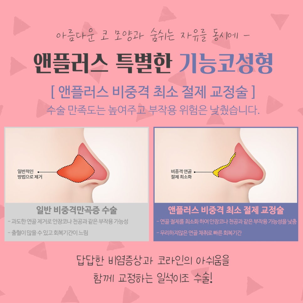 코수술후기 비중격만곡증까지 확인하여 관련 이미지 10