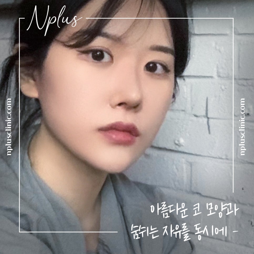 Nose Tip Surgery Review: Natural Results with Nose Tip Cartilage Stitching image 14