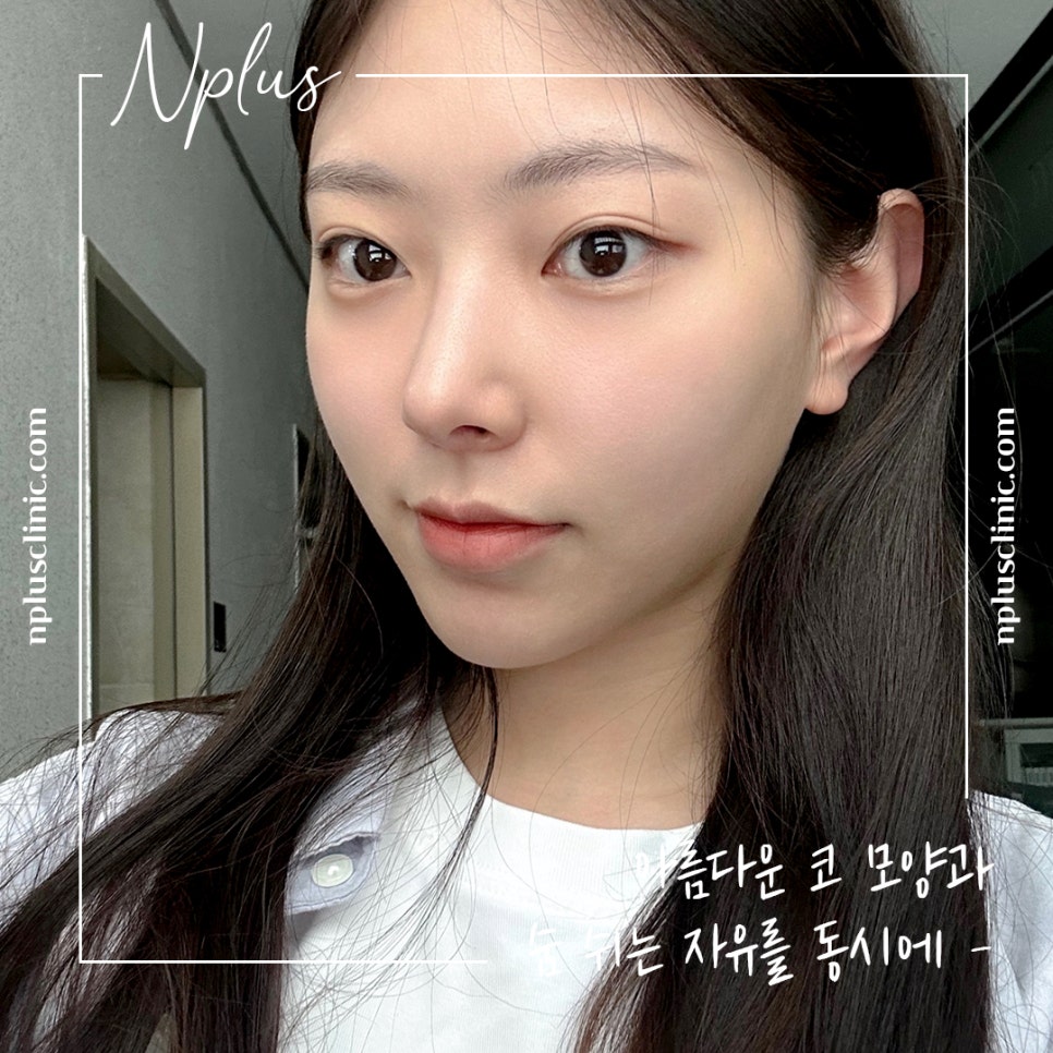 코성형후기 제대로 알아보고 관련 이미지 1