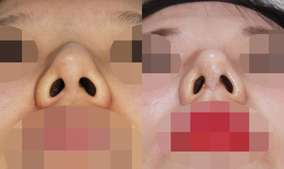 1_여자 매부리코 수술전후 관련 이미지 17