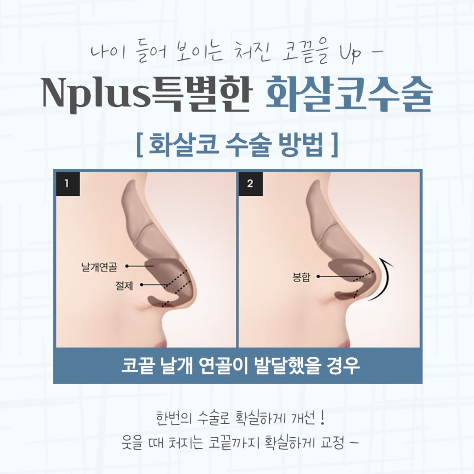 화살코수술 자세하게 알아보고 관련 이미지 8