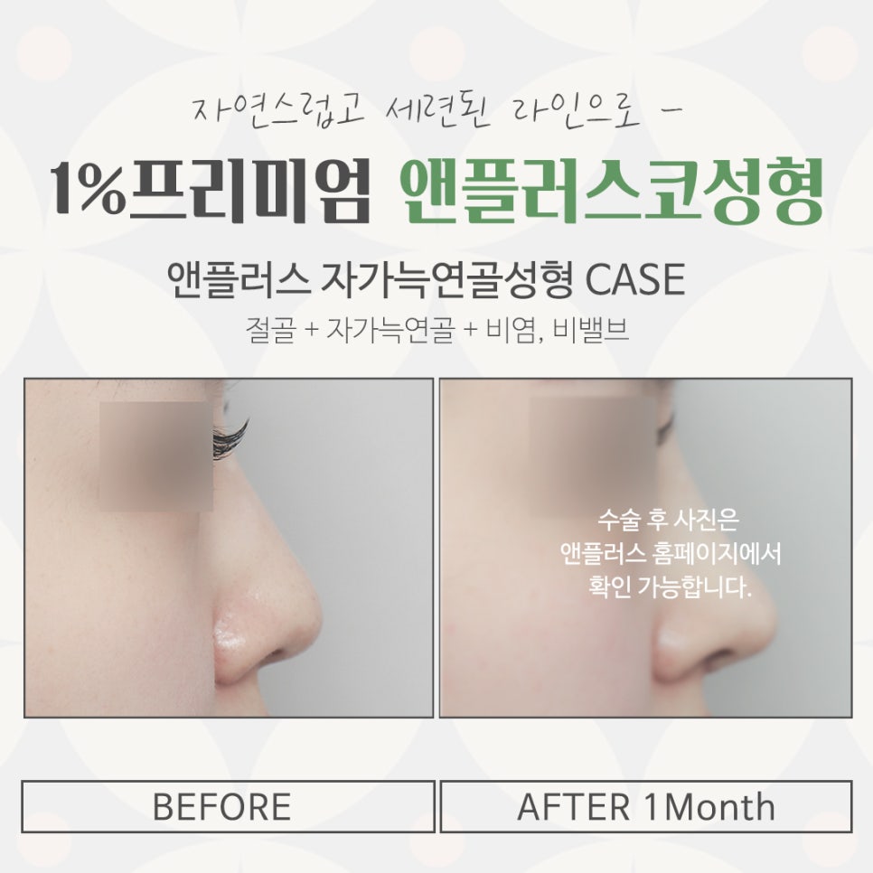 자가늑코수술에 대해 자세히 찾아보고 관련 이미지 15