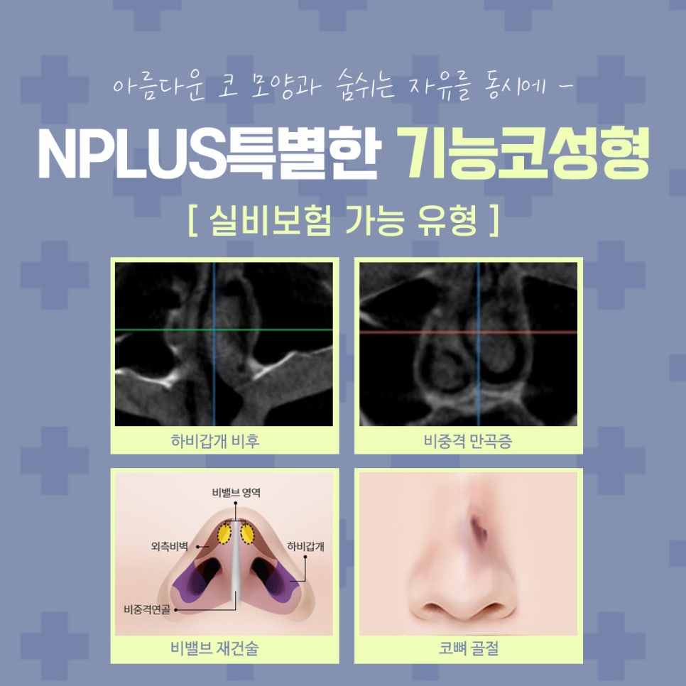 코수술보험 확실하게 알아보고 진행해야 관련 이미지 5