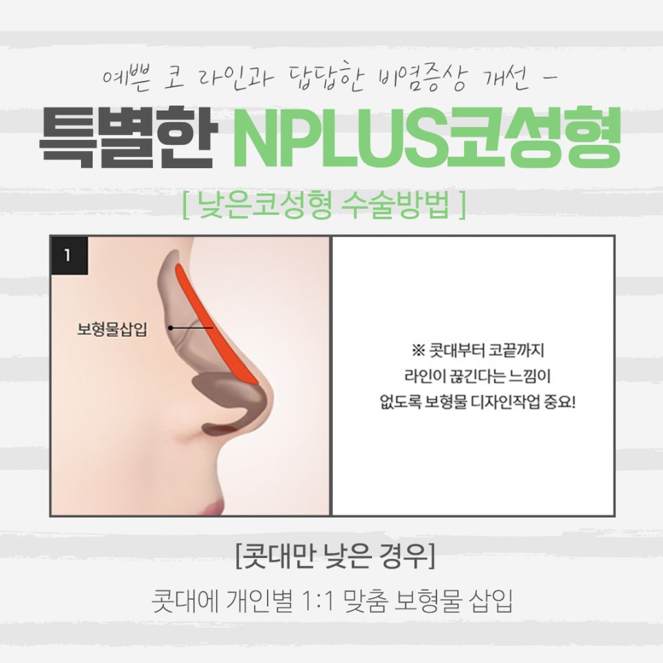 낮은코성형 후기에 대해 알아보고 관련 이미지 8