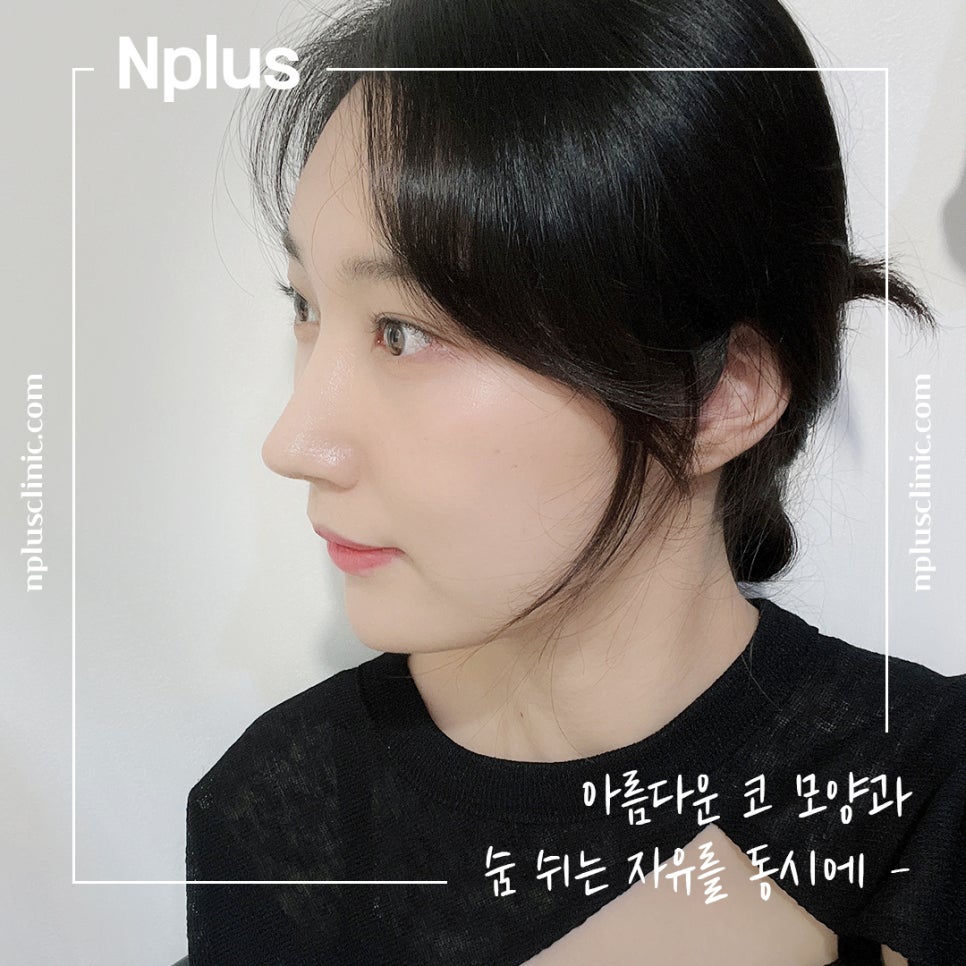 Before and After Nose Surgery: Looking into It Carefully image 1