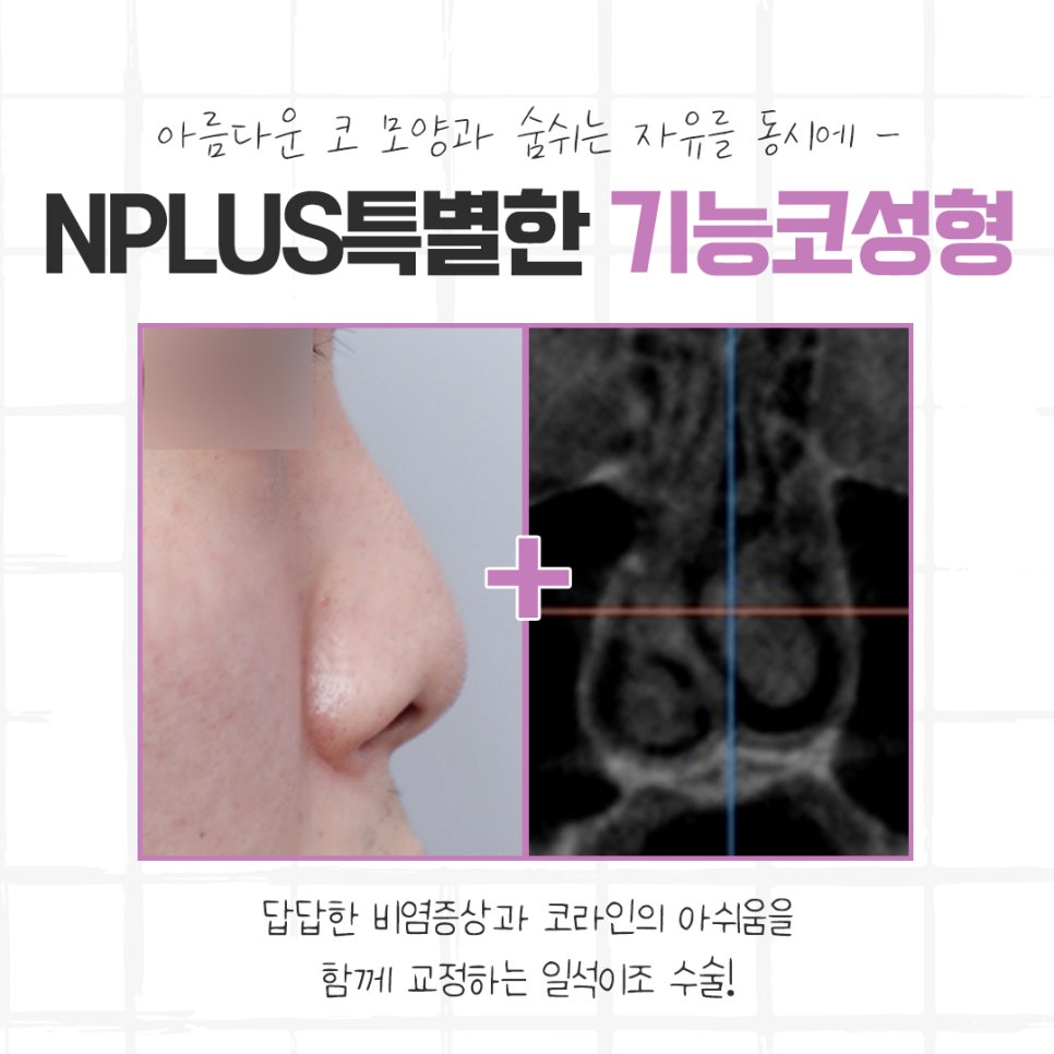 코성형후기 자연스럽고 아름답게 관련 이미지 8