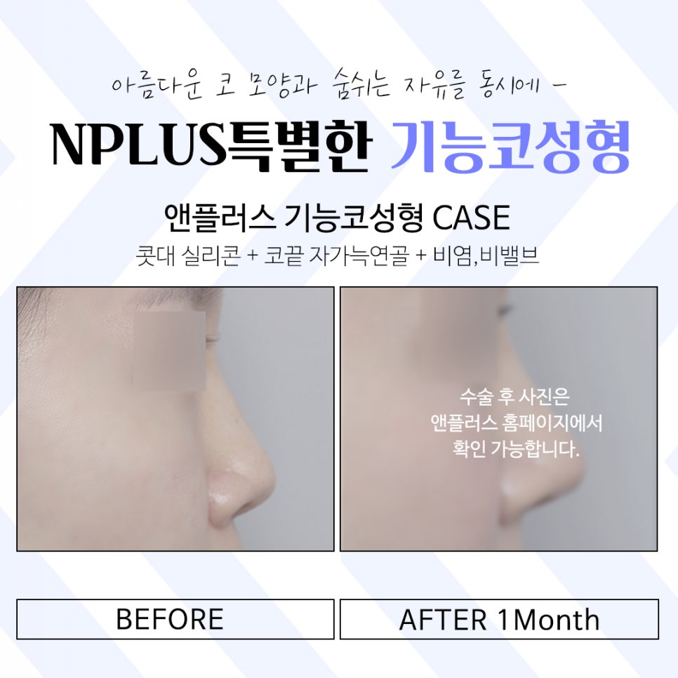 기능코성형후기 다양한 변화를 확인하여 관련 이미지 15