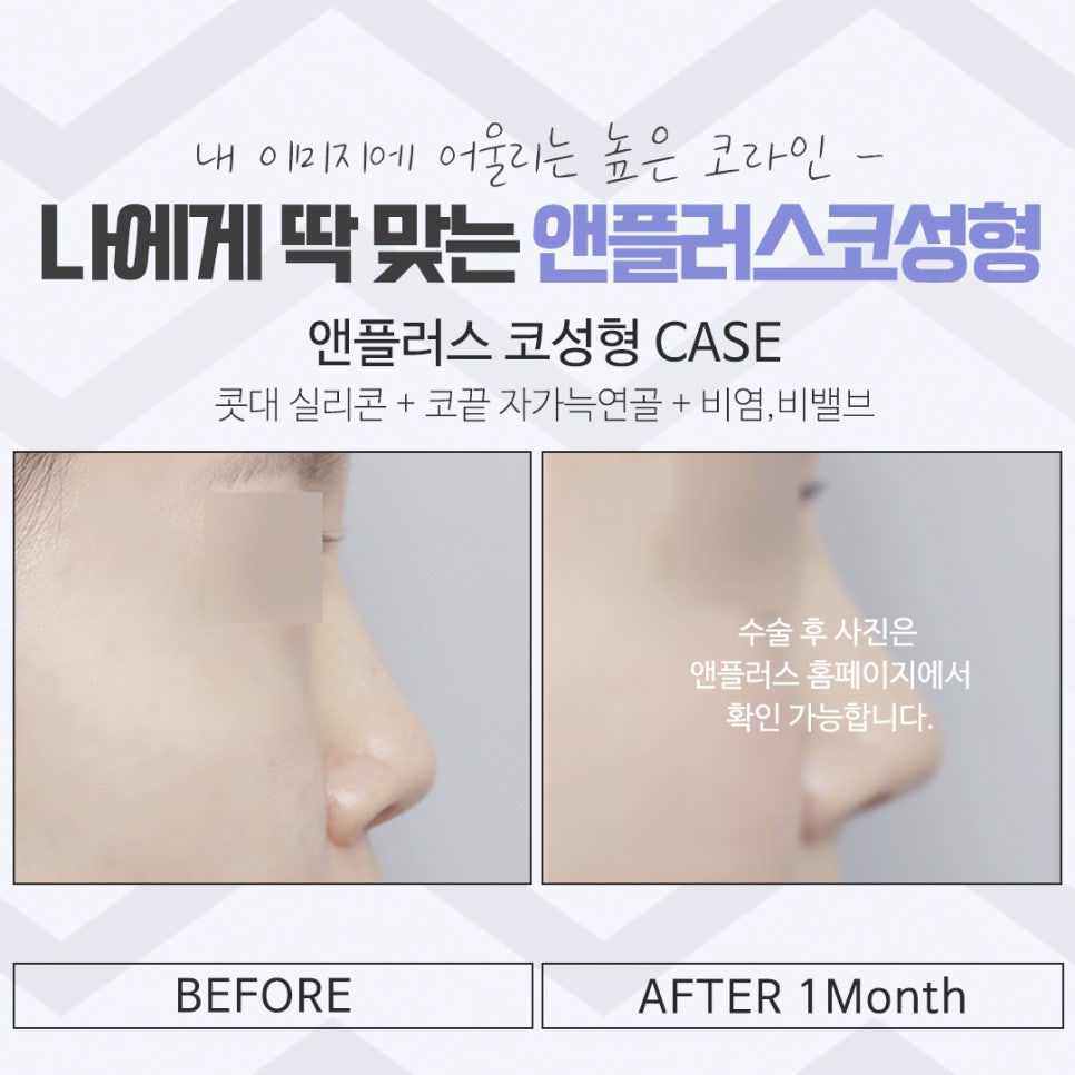 코성형후기 이미지를 예쁘고 자연스럽게 관련 이미지 16