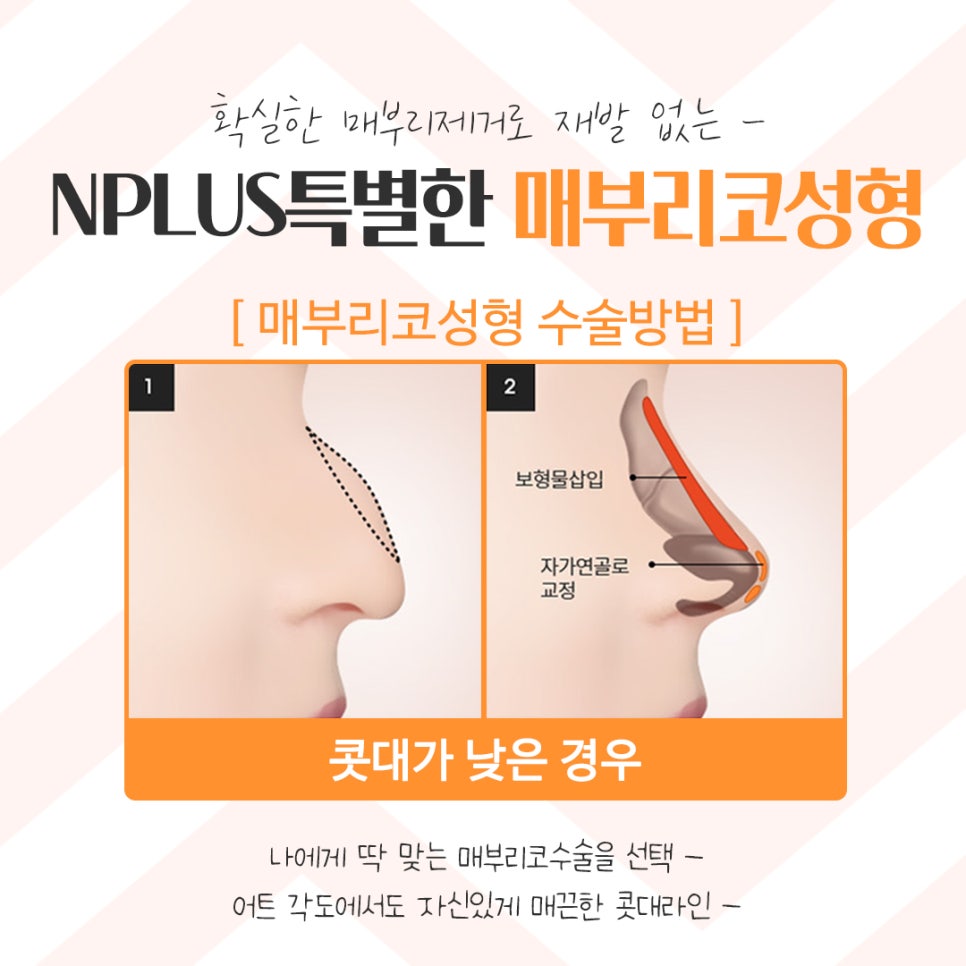 Hump Nose Surgery Review with a Clear Diagnosis image 10
