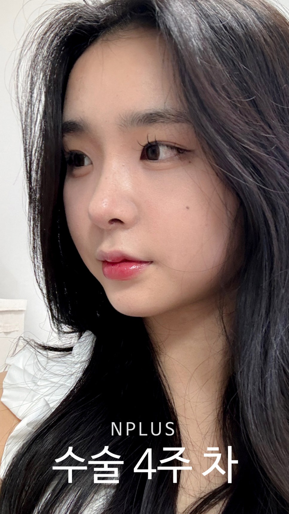 AN Plus Plastic Surgery Review: Silicone Nasal Bridge, Autologous Rib Cartilage Nasal Tip, Under-Eye Fat Repositioning, Fat Grafting image 10