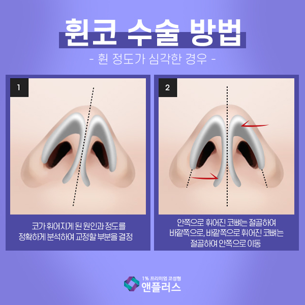 Crooked Nose Surgery at N+ image 7