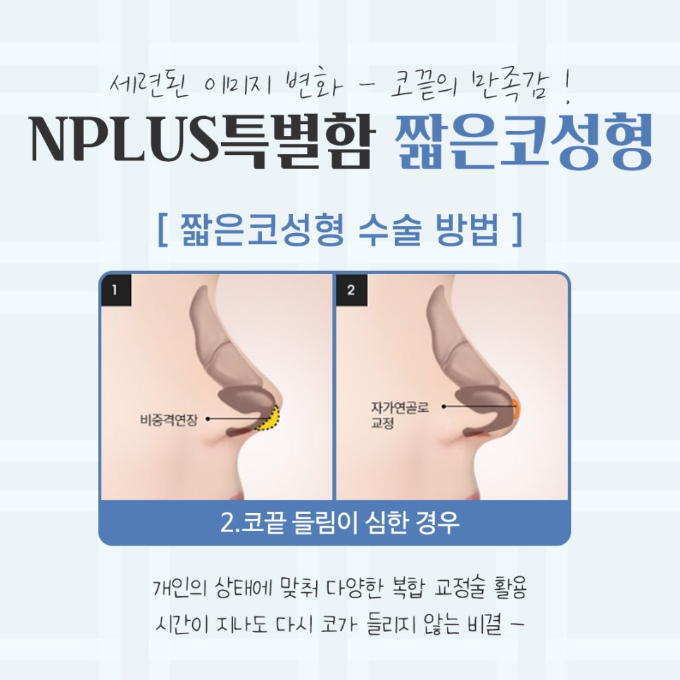 짧은코성형후기 자연스럽고 예쁘게 관련 이미지 9