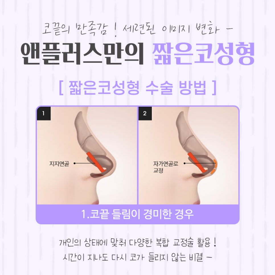 짧은코수술 후기까지 확실하게 관련 이미지 8