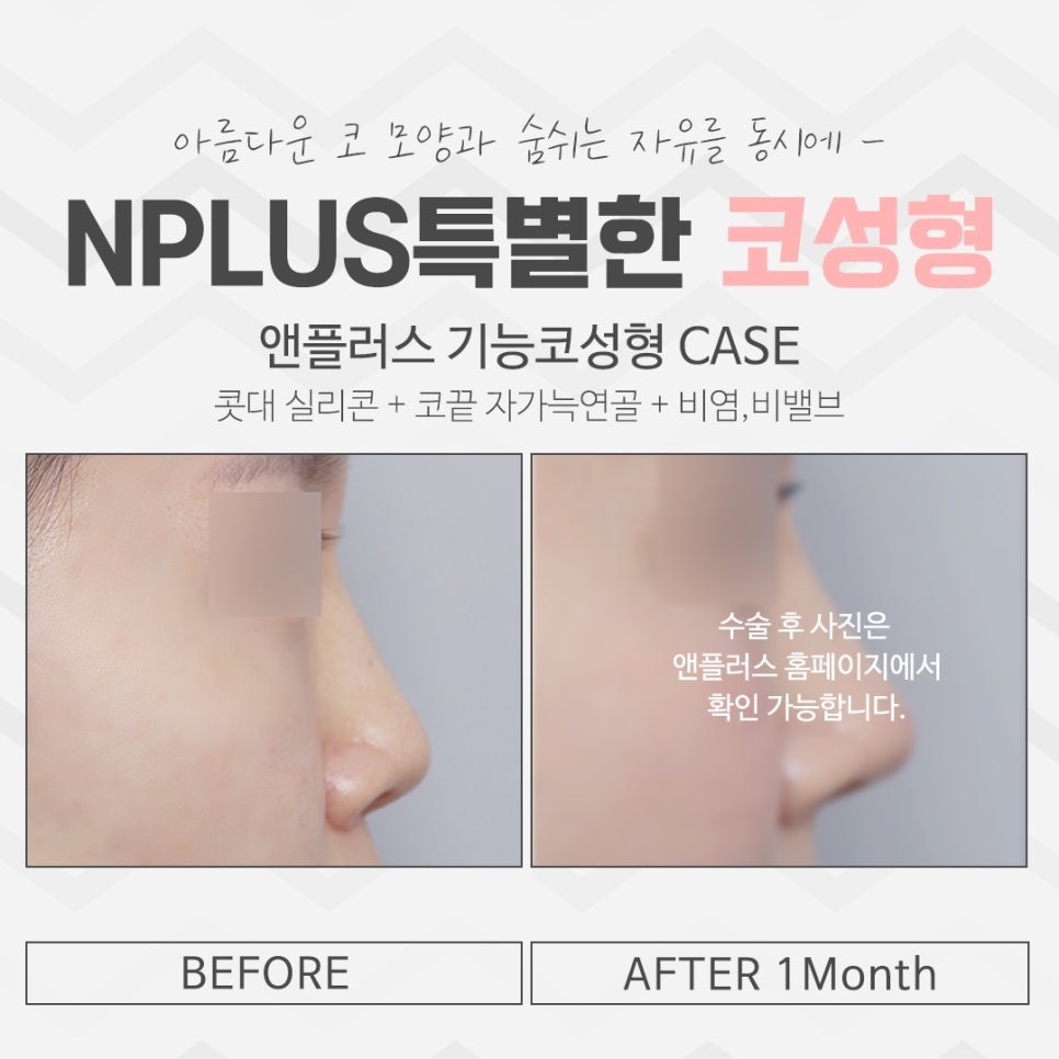 Building Confidence with a Refined Nose Line image 15