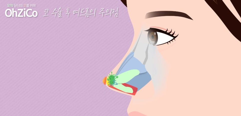 코수술후 코여드름 원인과 해결 방법 관련 이미지 16