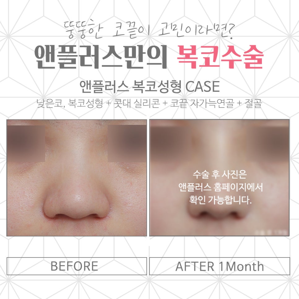 복코수술후기 뚱뚱한 코끝 개선 관련 이미지 4