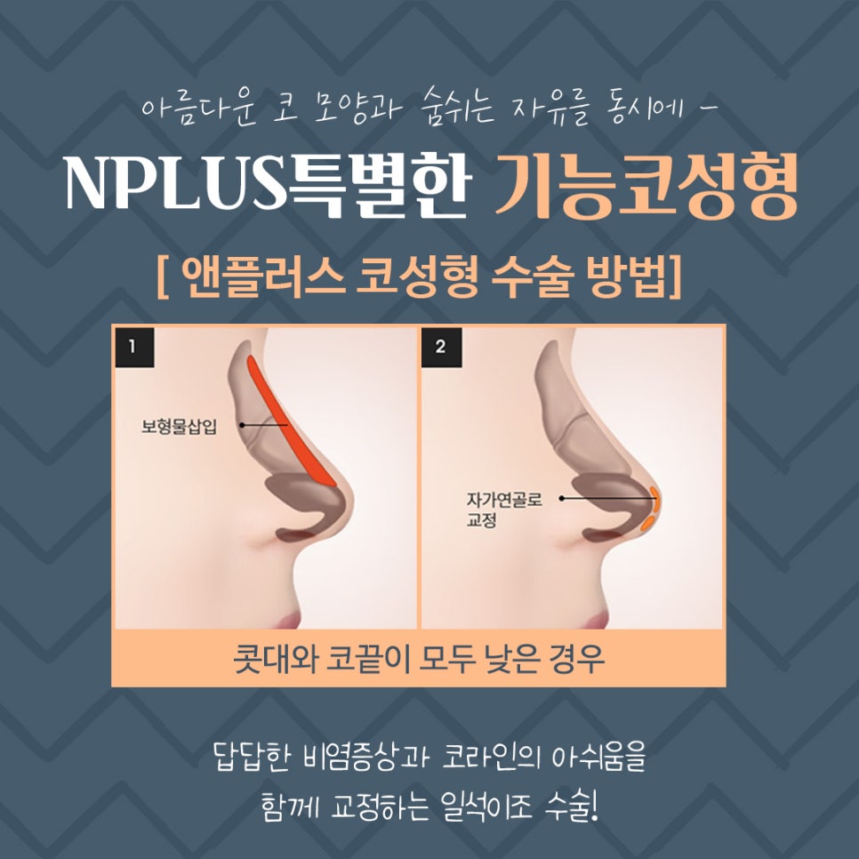 기능코성형후기 정확한 원인 분석으로 관련 이미지 11