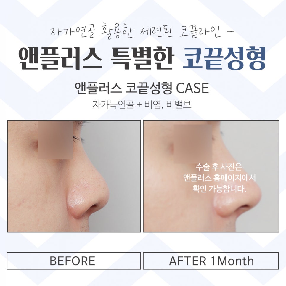 코끝성형 후기까지 확인하고 관련 이미지 15