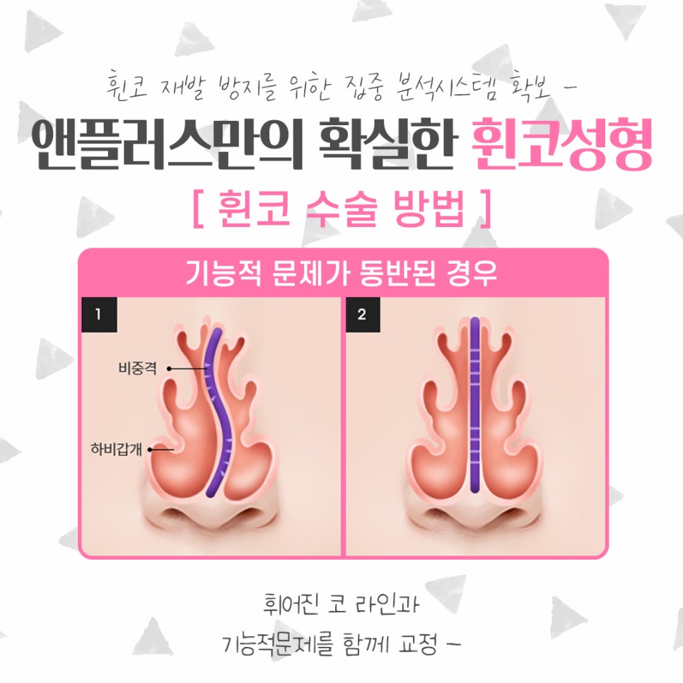 휜코수술후기를 자세하게 알아보고 관련 이미지 9