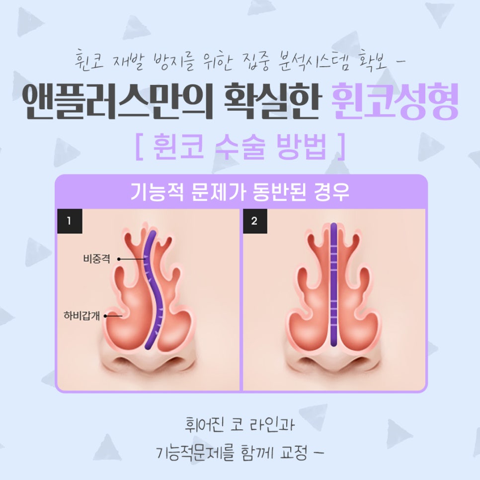 Taking a Thorough Look at Functional Deviated Nose Surgery image 11